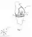 Fig. 02 - Position adjustable trial systems for prosthetic implants