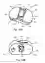 Fig. 35 - Position adjustable trial systems for prosthetic implants