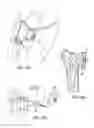 Fig. 06 - Distal radioulnar joint device
