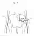 Fig. 113 - Method for controlling flow in a bodily organ