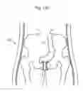 Fig. 114 - Method for controlling flow in a bodily organ