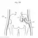 Fig. 115 - Method for controlling flow in a bodily organ