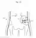 Fig. 116 - Method for controlling flow in a bodily organ