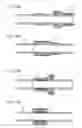 Fig. 120 - Method for controlling flow in a bodily organ