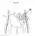 Fig. 121 - Method for controlling flow in a bodily organ