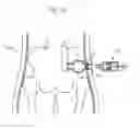 Fig. 133 - Method for controlling flow in a bodily organ