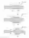 Fig. 150 - Method for controlling flow in a bodily organ