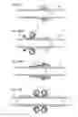 Fig. 172 - Method for controlling flow in a bodily organ