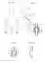 Fig. 177 - Method for controlling flow in a bodily organ