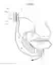 Fig. 44 - Method for controlling flow in a bodily organ