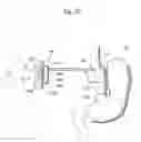 Fig. 46 - Method for controlling flow in a bodily organ
