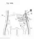 Fig. 82 - Method for controlling flow in a bodily organ