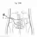 Fig. 83 - Method for controlling flow in a bodily organ