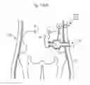 Fig. 94 - Method for controlling flow in a bodily organ