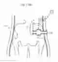 Fig. 95 - Method for controlling flow in a bodily organ