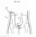 Fig. 96 - Method for controlling flow in a bodily organ