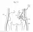 Fig. 97 - Method for controlling flow in a bodily organ