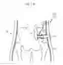 Fig. 98 - Method for controlling flow in a bodily organ