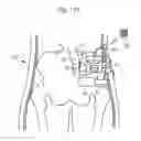 Fig. 99 - Method for controlling flow in a bodily organ
