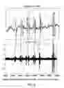 Fig. 04 - Method for detecting and filtering a random noise signal