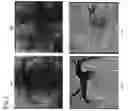 Fig. 04 - Catheter RF ablation using segmentation-based 2D-3D registration