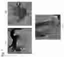 Fig. 08 - Catheter RF ablation using segmentation-based 2D-3D registration