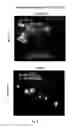 Fig. 45 - METHODS AND COMPOSITIONS FOR TREATING ATHEROSCLEROSIS AND RELATED CONDIDTIONS