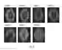 Fig. 02 - Antifungal Bone Cements