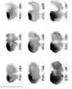 Fig. 24 - Method for treating stroke via administration of NEP1-40 and inosine