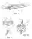 Fig. 09 - Implantable restriction system with release mechanism