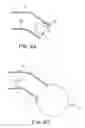 Fig. 05 - Penile prosthesis insertion tool and system