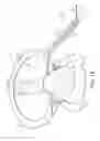 Fig. 09 - Penile prosthesis cap and assembly