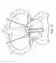 Fig. 10 - Penile prosthesis cap and assembly