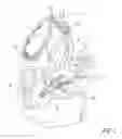 Fig. 03 - Applicator for endoscopic treatment of biliary disease