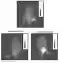 Fig. 01 - FUNCTIONAL NEAR-INFRARED FLUORESCENCE LYMPHATIC MAPPING FOR DIAGNOSING, ACCESSING, MONITORING AND DIRECTING THERAPY OF LYMPHATIC DISORDERS