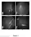 Fig. 02 - FUNCTIONAL NEAR-INFRARED FLUORESCENCE LYMPHATIC MAPPING FOR DIAGNOSING, ACCESSING, MONITORING AND DIRECTING THERAPY OF LYMPHATIC DISORDERS