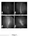 Fig. 03 - FUNCTIONAL NEAR-INFRARED FLUORESCENCE LYMPHATIC MAPPING FOR DIAGNOSING, ACCESSING, MONITORING AND DIRECTING THERAPY OF LYMPHATIC DISORDERS