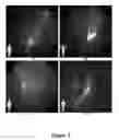 Fig. 04 - FUNCTIONAL NEAR-INFRARED FLUORESCENCE LYMPHATIC MAPPING FOR DIAGNOSING, ACCESSING, MONITORING AND DIRECTING THERAPY OF LYMPHATIC DISORDERS