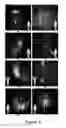 Fig. 05 - FUNCTIONAL NEAR-INFRARED FLUORESCENCE LYMPHATIC MAPPING FOR DIAGNOSING, ACCESSING, MONITORING AND DIRECTING THERAPY OF LYMPHATIC DISORDERS