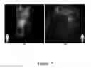 Fig. 08 - FUNCTIONAL NEAR-INFRARED FLUORESCENCE LYMPHATIC MAPPING FOR DIAGNOSING, ACCESSING, MONITORING AND DIRECTING THERAPY OF LYMPHATIC DISORDERS