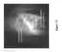Fig. 18 - FUNCTIONAL NEAR-INFRARED FLUORESCENCE LYMPHATIC MAPPING FOR DIAGNOSING, ACCESSING, MONITORING AND DIRECTING THERAPY OF LYMPHATIC DISORDERS