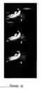 Fig. 19 - FUNCTIONAL NEAR-INFRARED FLUORESCENCE LYMPHATIC MAPPING FOR DIAGNOSING, ACCESSING, MONITORING AND DIRECTING THERAPY OF LYMPHATIC DISORDERS