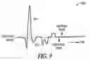Fig. 08 - MORPHOLOGY BASED ISCHEMIA DETECTION USING INTRACARDIAC ELECTROGRAMS