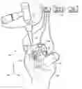 Fig. 01 - System and method for preventing intraoperative fracture in cementless hip arthroplasty