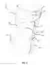 Fig. 06 - Hyperextension brace assembly and methods of use