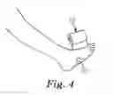 Fig. 04 - Compression bandage system