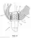 Fig. 17 - METHOD AND APPARATUS FOR SUTURELESSLY CONNECTING A CONDUIT TO A HOLLOW ORGAN