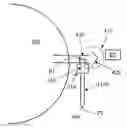 Fig. 01 - Lumen clearing valve for glaucoma drainage device