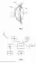 Fig. 02 - Glaucoma drainage device with pump