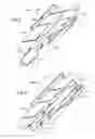 Fig. 06 - Glaucoma drainage device with pump